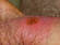 There are several stages of syphilis, and the early stages are much easier to treat. (sl.wikipedia.org)