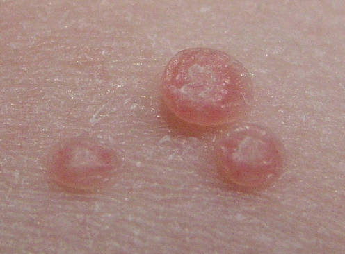 Don't allow yourself to scratch these itchy little "pimples"!