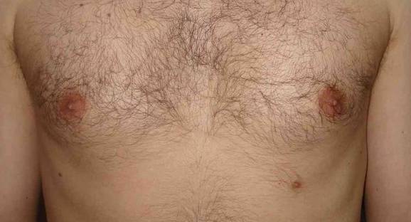 Almost ten percent of people have are born with a third nipple.