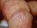A milder form of balanitis.