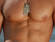 gynaecomastia