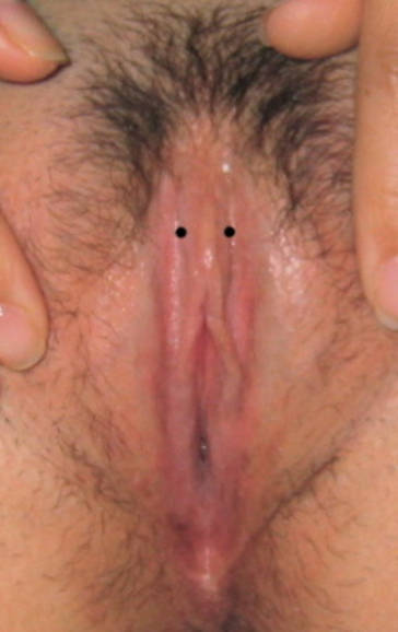 hch placement
