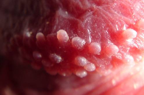 The pearly penile papules appear on the inner side of the coronal margin of the glans penis. Sometimes they spread over the surface of the glans.