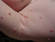 These small papulae can be a sign of an infection with the virus Molluscum Contagiosum, which is most easily transmitted through sexual contact.