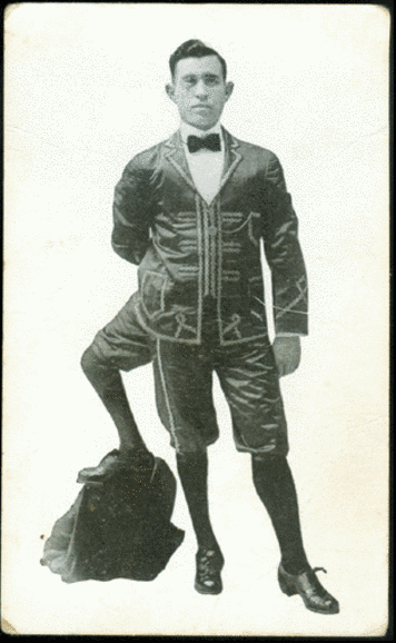 A man with 3 legs, 4 feet, 2 penises. Francesco Lentini (1889 - 22 September 1966)