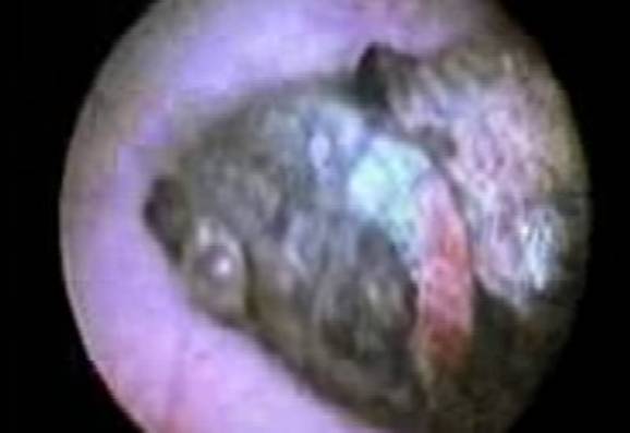 The fish had to be removed from his bladder by physicians.