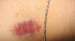 hickey