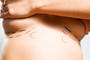The most common reasons for breast enlargement are asymmetries, sagging breasts or a desire to have larger breasts. (Photoxpress)