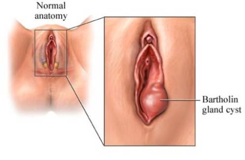 Bartolin’s glands may be blocked and become infected.