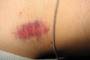 Cool the hickey immediately after it forms.