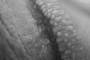Pearly penile papules