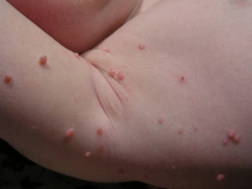 These small papulae can be a sign of an infection with the virus Molluscum Contagiosum, which is most easily transmitted through sexual contact.