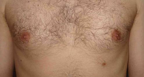 Almost ten percent of people have are born with a third nipple.