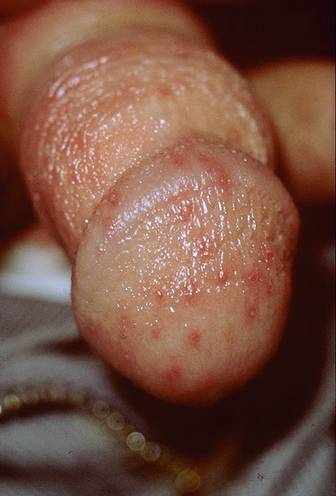 A milder form of balanitis.