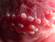 The pearly penile papules appear on the inner side of the coronal margin of the glans penis. Sometimes they spread over the surface of the glans.
