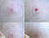 pull out ingrown hair