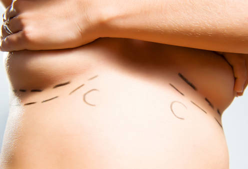 The most common reasons for breast enlargement are asymmetries, sagging breasts or a desire to have larger breasts. (Photoxpress)