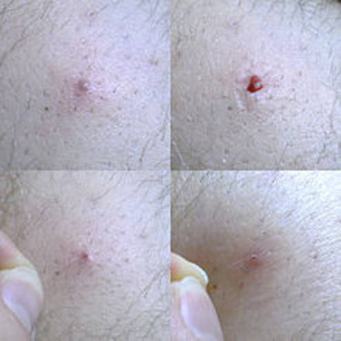 pull out ingrown hair